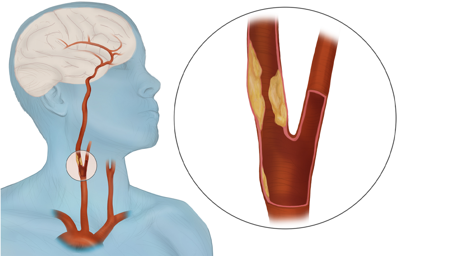 Carotid Artery Disease Specialist
